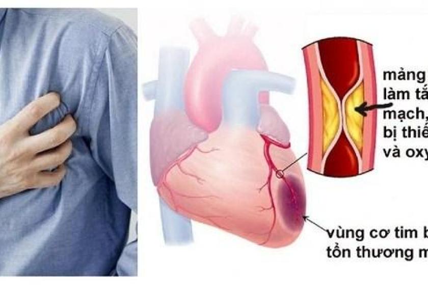 Nhồi máu cơ tim: Triệu chứng, nguyên nhân và cách điều trị